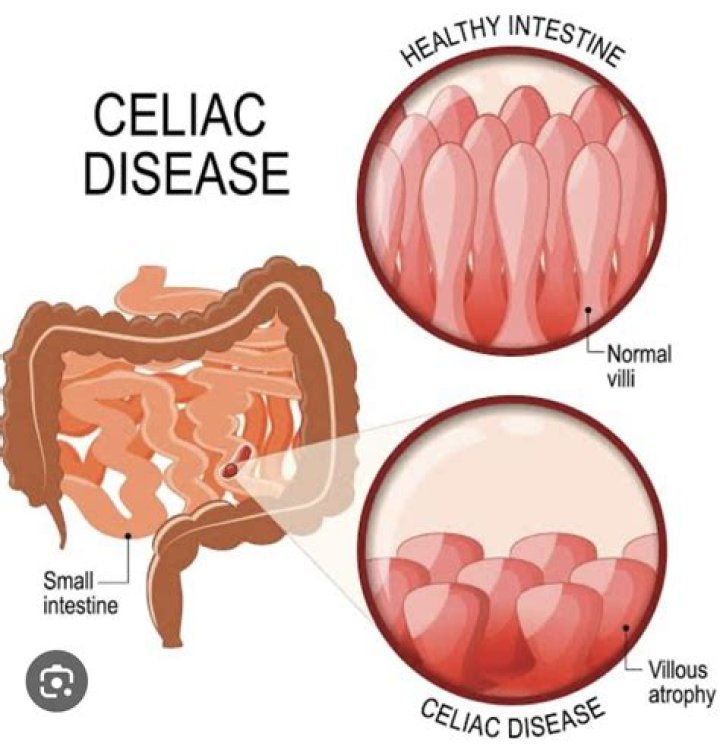 In celiac sprue disease?
