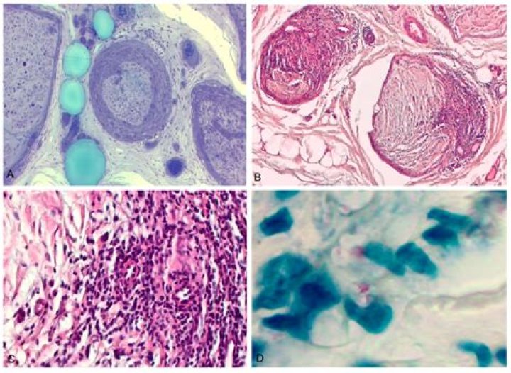 In neuritic leprosy which nerve is thickened?