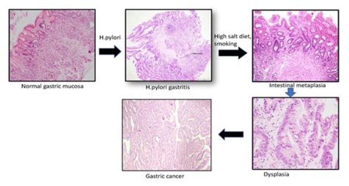 In pathology what is dysplasia?