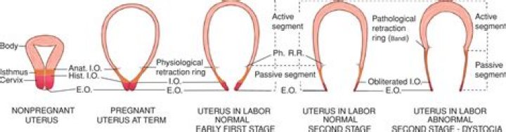 In upper uterine segment?