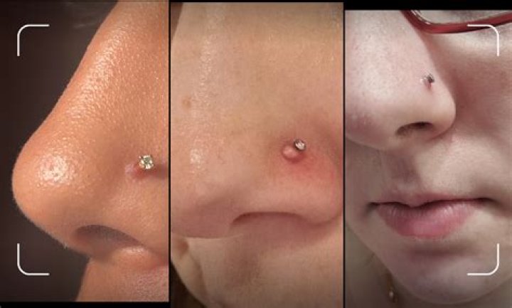 Inside nose piercing closed?