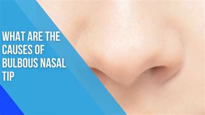 Is a bulbous nose a sign of alcoholism?