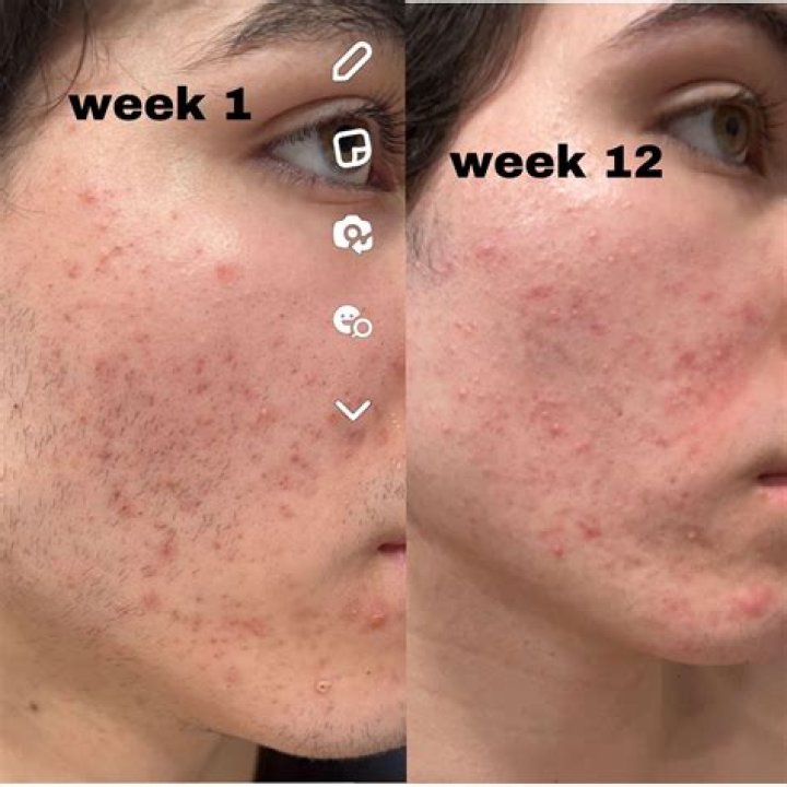 Is adapalene good for acne?