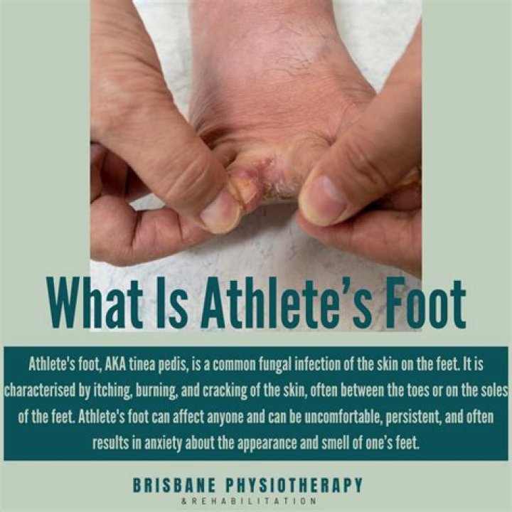 Is athlete's foot treatment?