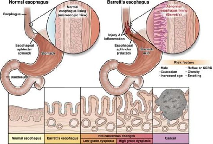 Is barrett's esophagus curable?