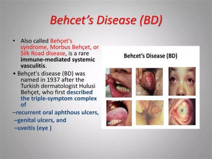 Is behcet's disease curable?