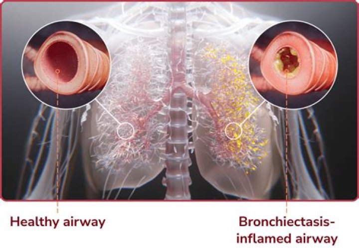 Is bronchiectasis a disability?