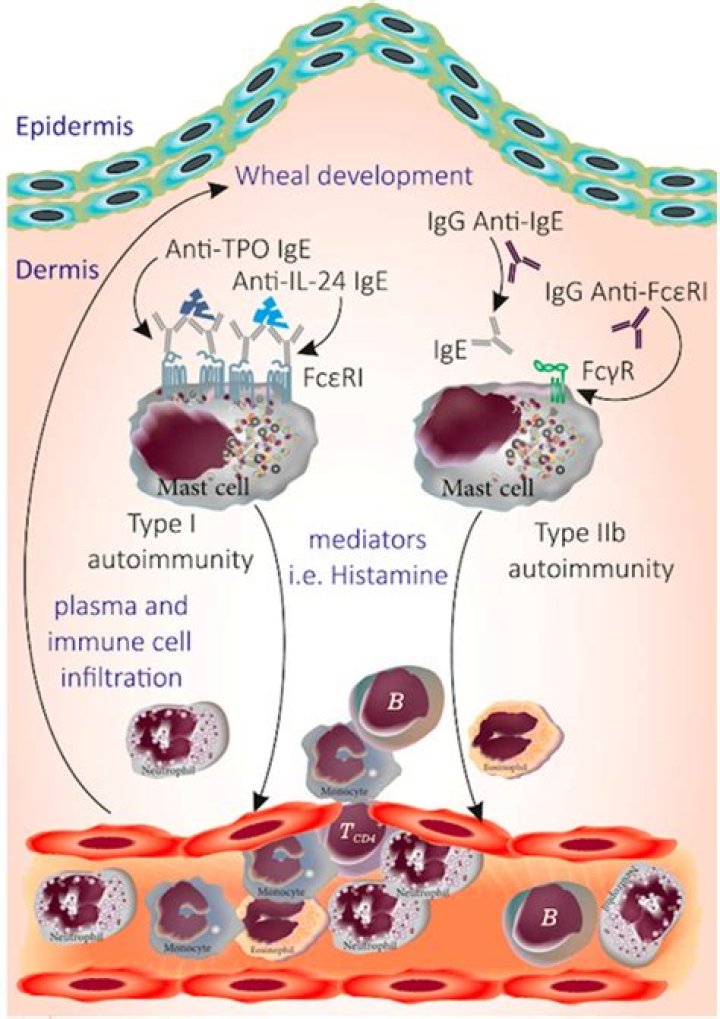 Is cholinergic urticaria an autoimmune disease?