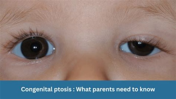 Is congenital ptosis hereditary?