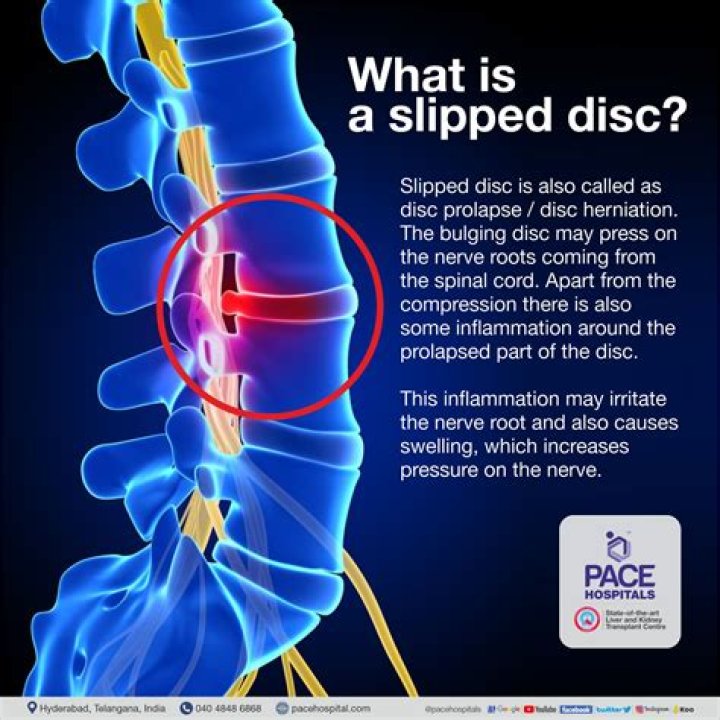 Is cycling good for slipped disc?