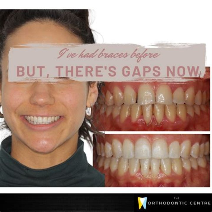 Is gaps in teeth attractive?