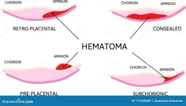 Is hematoma a blood clot?