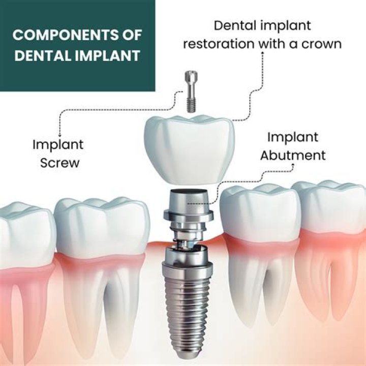 Is implant tooth good?