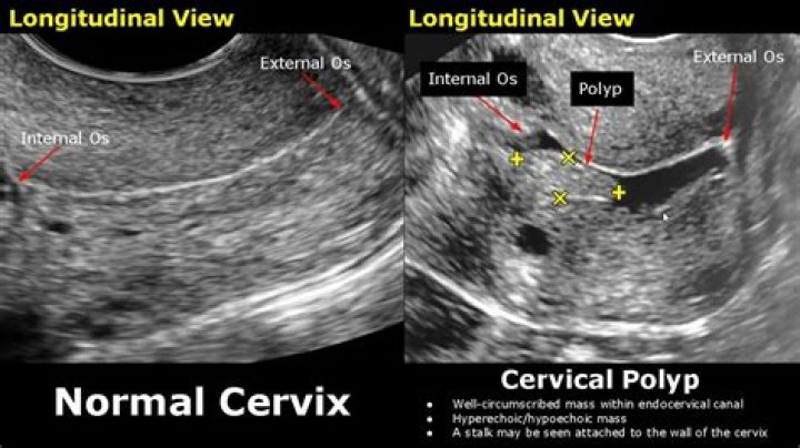 Is it normal to have 2 cervix?