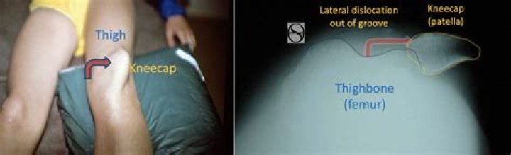 Is it possible to not have kneecaps?