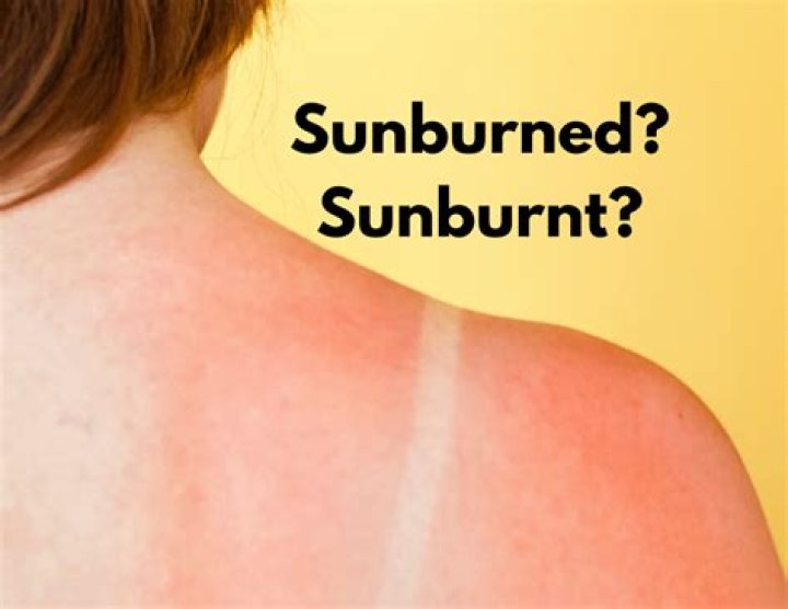 Is it sunburned or sunburnt?