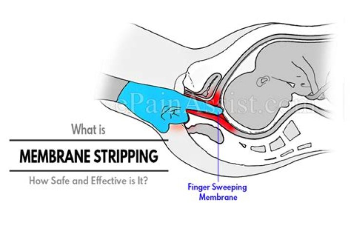 Is membrane sweep effective?