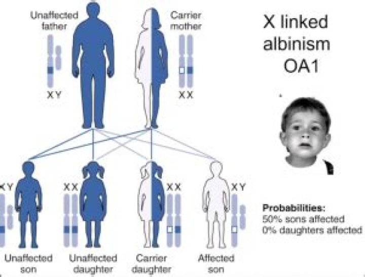Is oculocutaneous albinism x linked?