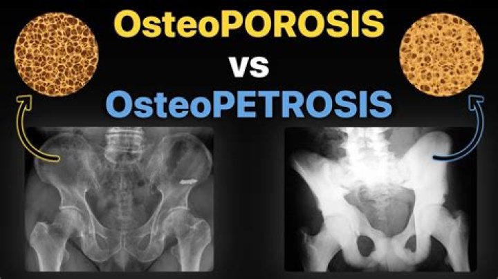 Is osteopetrosis a disease or disorder?