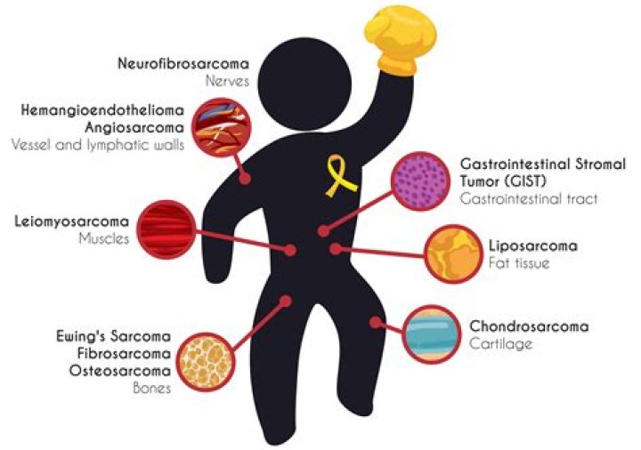 Is sarcoma cancer hereditary?