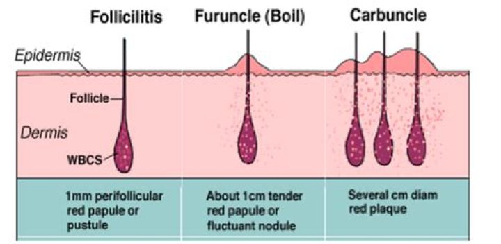 Is the difference between a furuncle and a carbuncle?