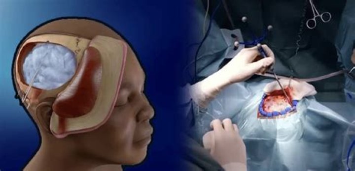 Is trepanation a craniotomy?