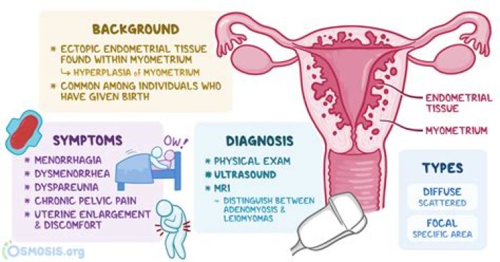 Is uterine leiomyomas genetic?