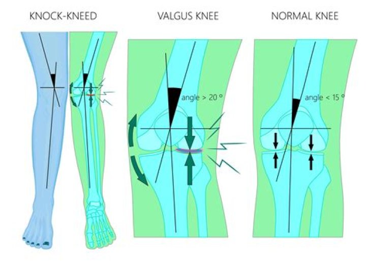Is valgus knee genetic?