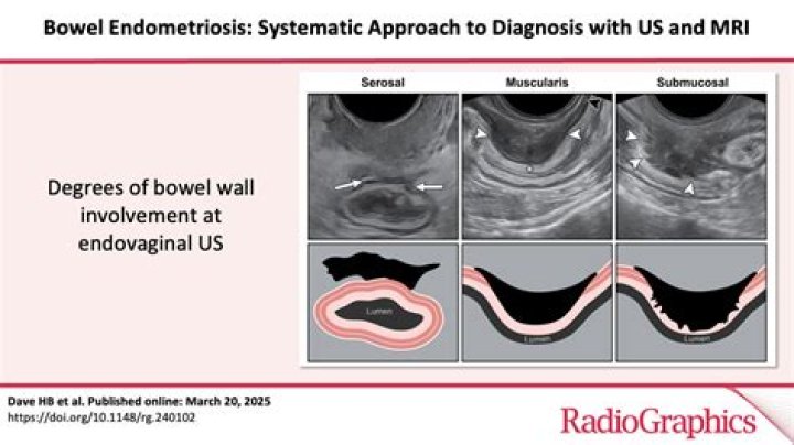 Should endometriosis be removed?