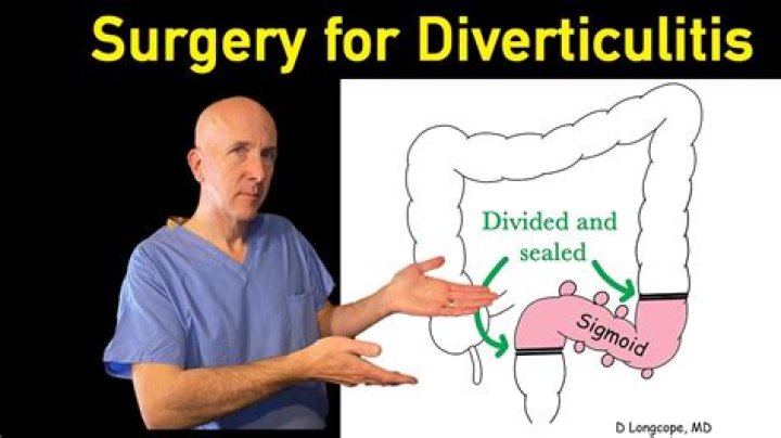 Should i have colon surgery for diverticulitis?