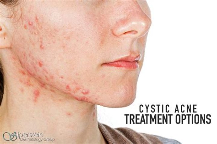 Should i ice cystic acne?