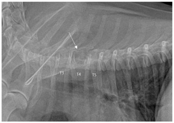 Should intramuscular lipomas be removed?