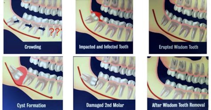 Should molars touch at rest?