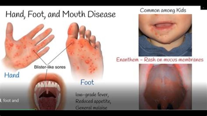 What antibiotics treat hand foot and mouth?