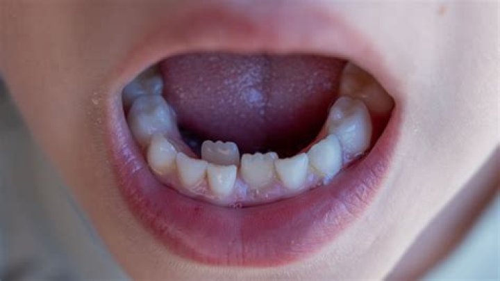 What are temporaries teeth?