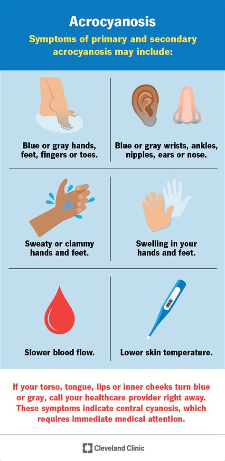 What causes acrocyanosis in adults?