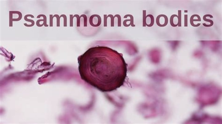 What causes psammoma bodies?