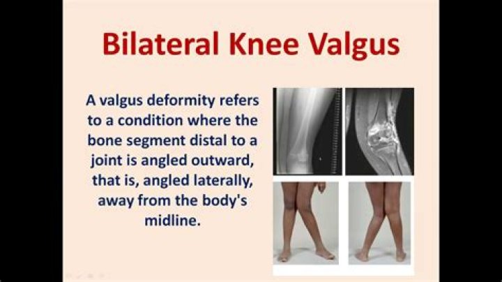 What causes valgus deformity?