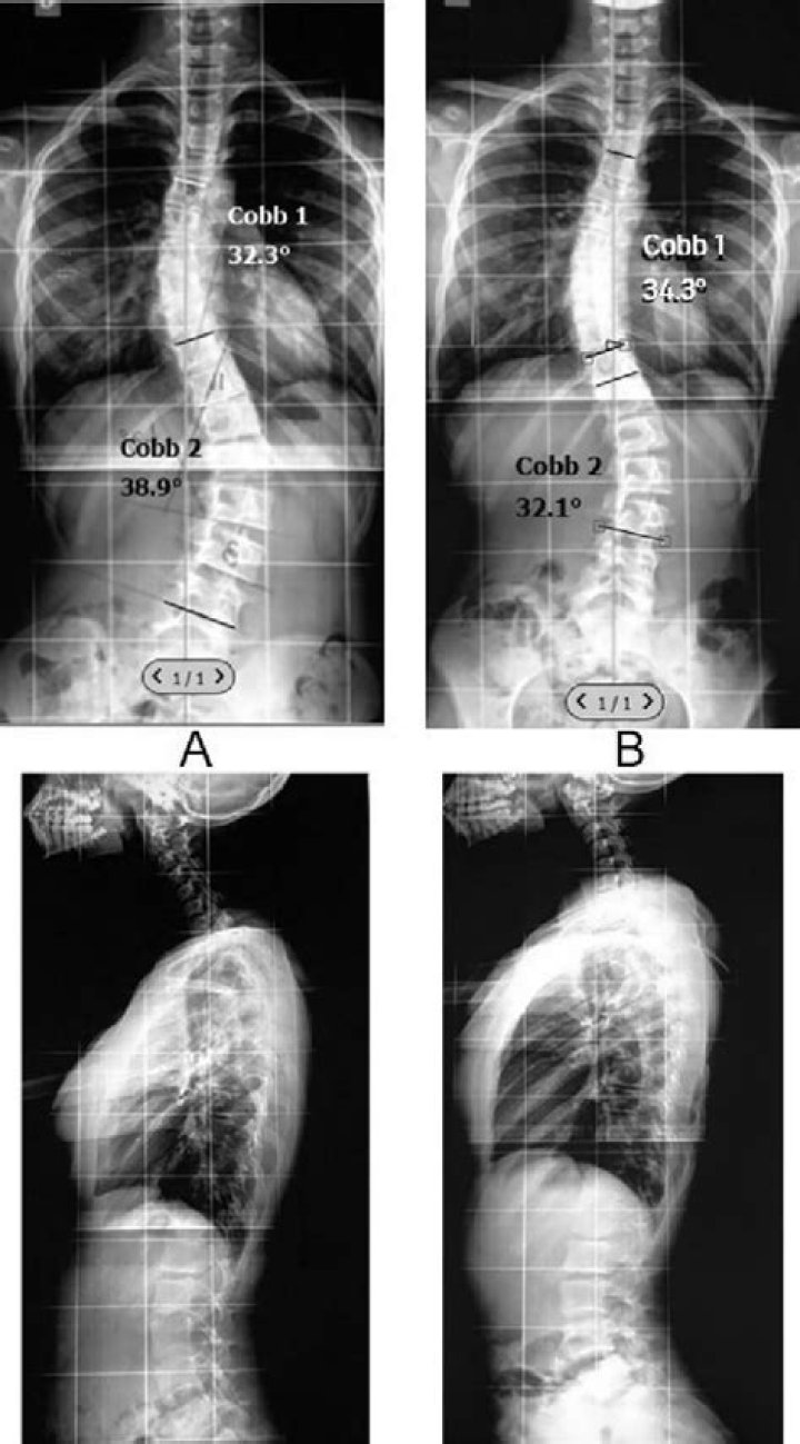 What degree of curvature is considered scoliosis?