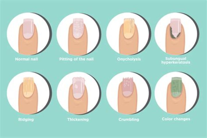 What do divots in fingernails mean?