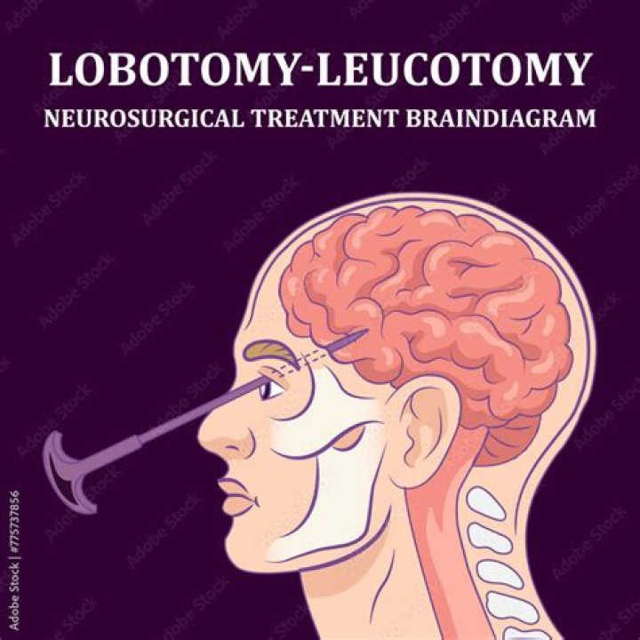 What does a prefrontal lobotomy do?