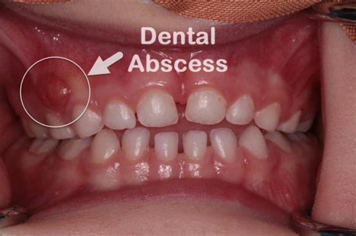 What does an abscess look like?