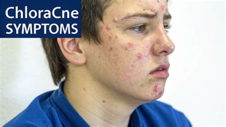 What does chloracne mean?