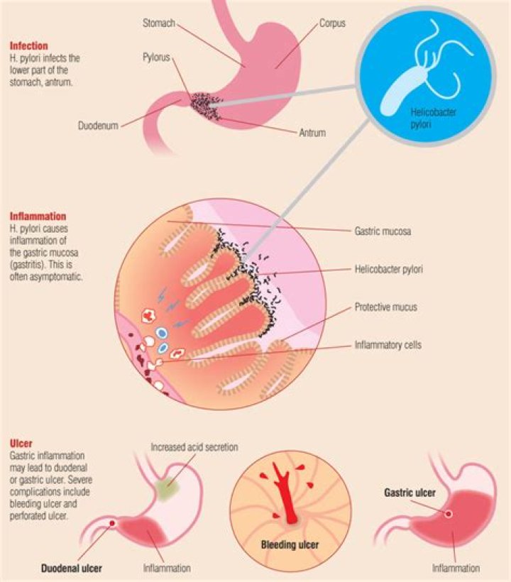 What does helicobacter pylori cause?