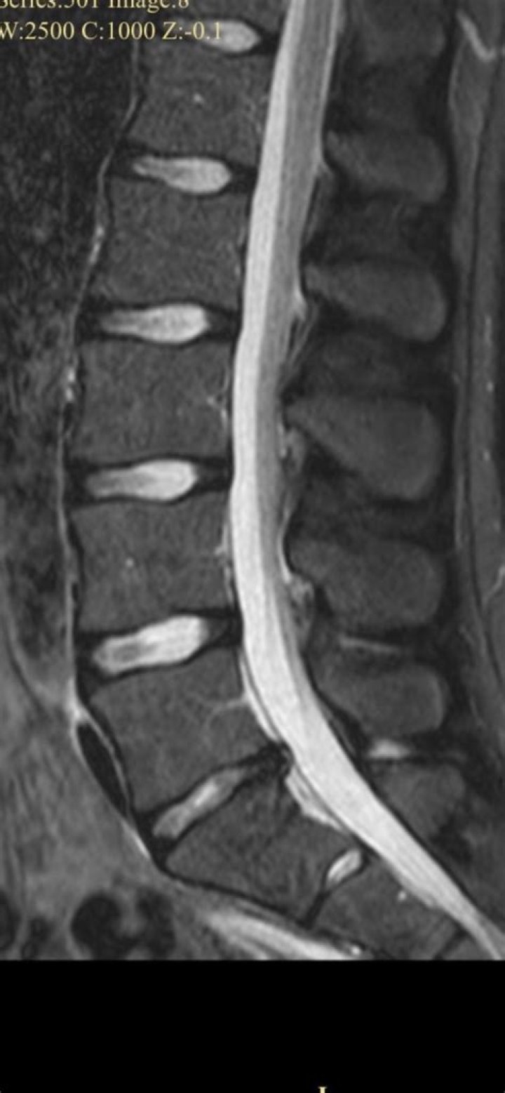 What does impinges upon mean?