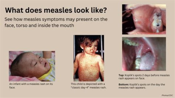 What does measles do?