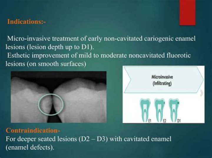 What does non-cavitated mean?