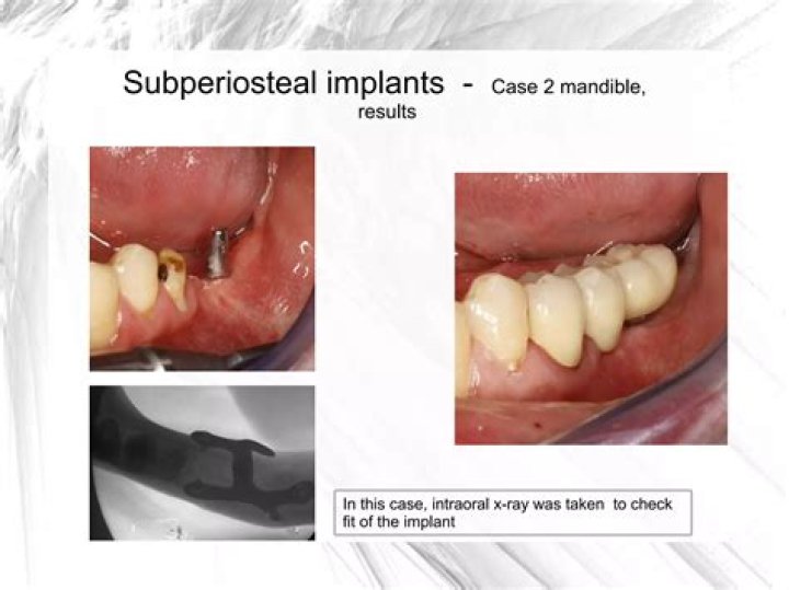 What does subperiosteally mean?