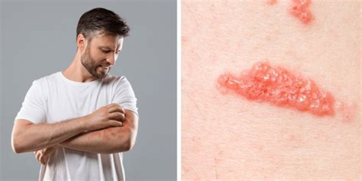 What does urushiol do to your skin?