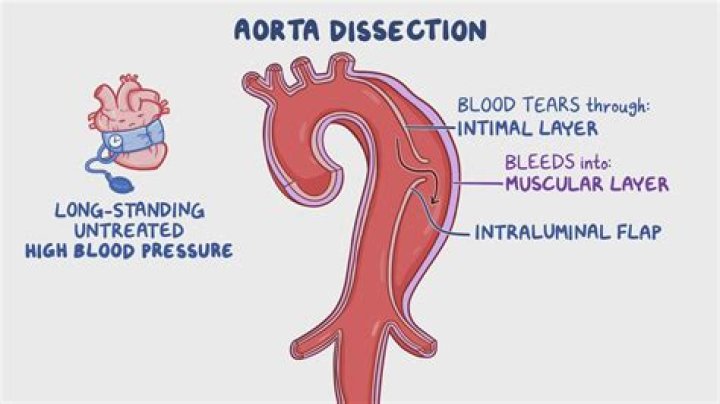 What happens when an artery dissection?